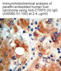immunohistochemistry staining human liver cancer tissues using anti CTRP3 (human) antibody