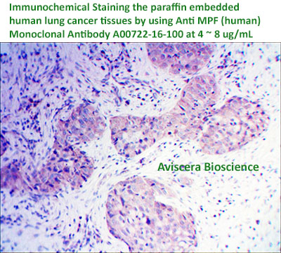 immunostaining lung cancer tissues by anti MPF (Human) Monoclonal antibody A00722-16-100